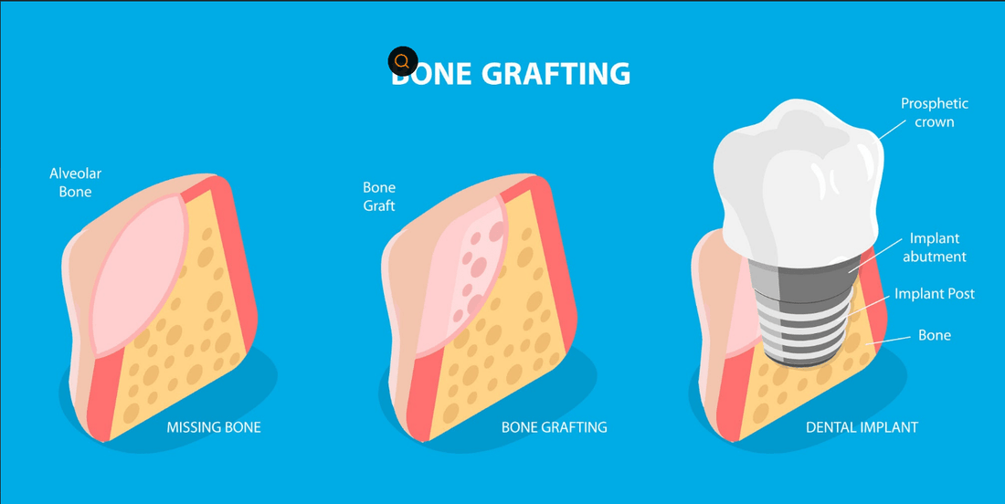 What Is a Bone Graft - eedas.com