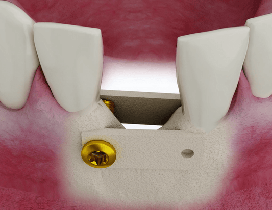 What is the Purpose of GBR? - EEDAS Dental
