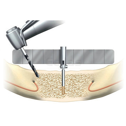 All - on - 4 Guide Surgical Template - EEDAS Dental